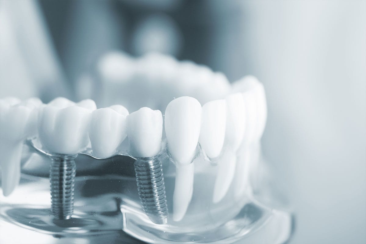 Bicon Dental Implants | Product Information | SHORT® Implants