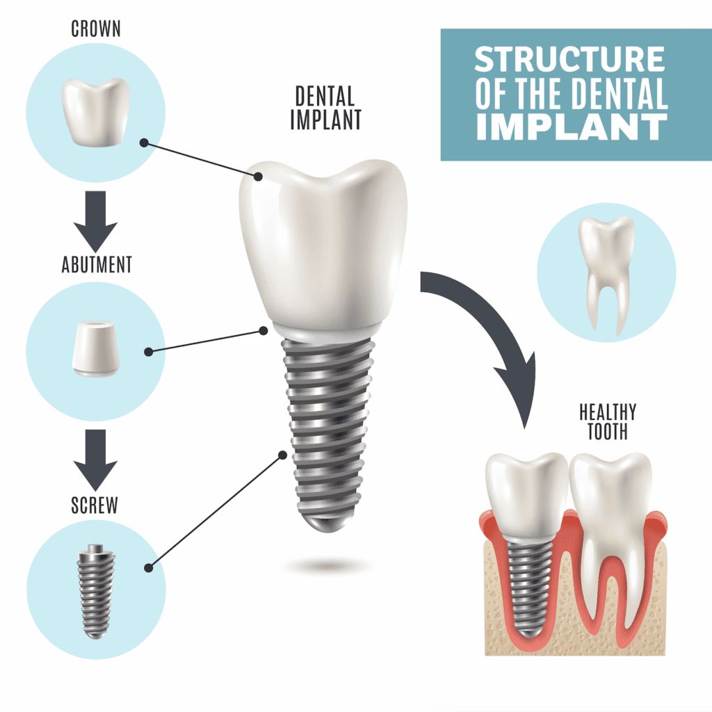 infographic for what do dental implants look like