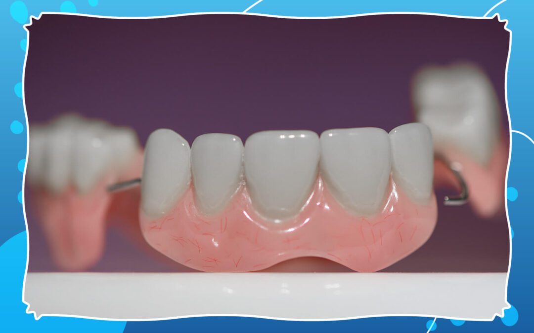 How Much Does a Dental Bridge Cost?