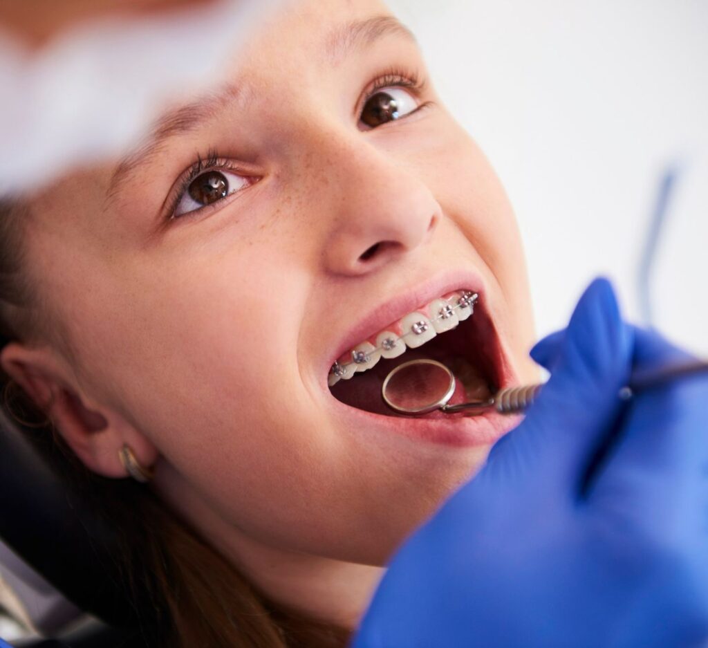 female patient with clear and metal braces receiving orthodontic treatment in fort mill