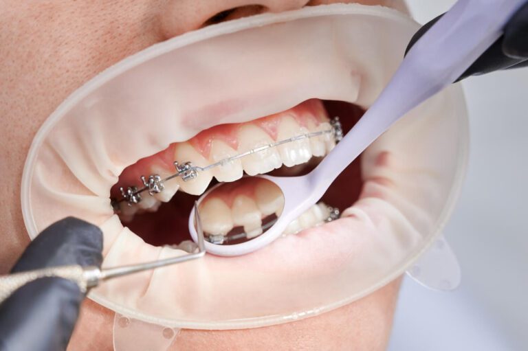 Close up of dentist attaching metal braces to patient teeth explaining how braces work