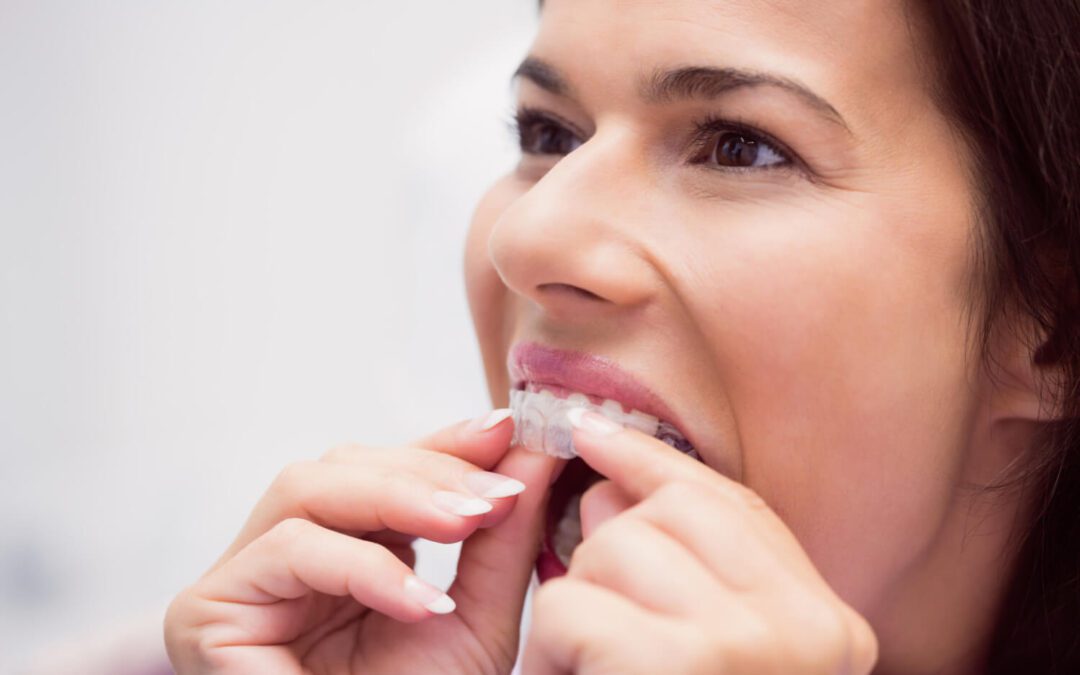 Is Invisalign Faster Than Braces?