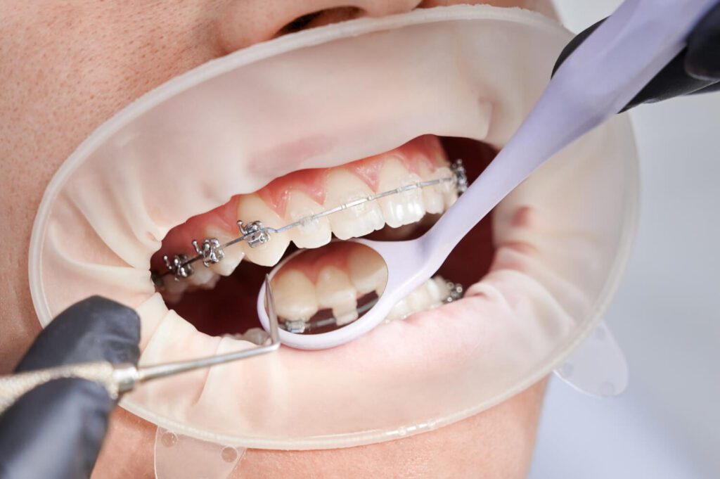 Clear Braces vs Metal Braces: Which Is Right for You?