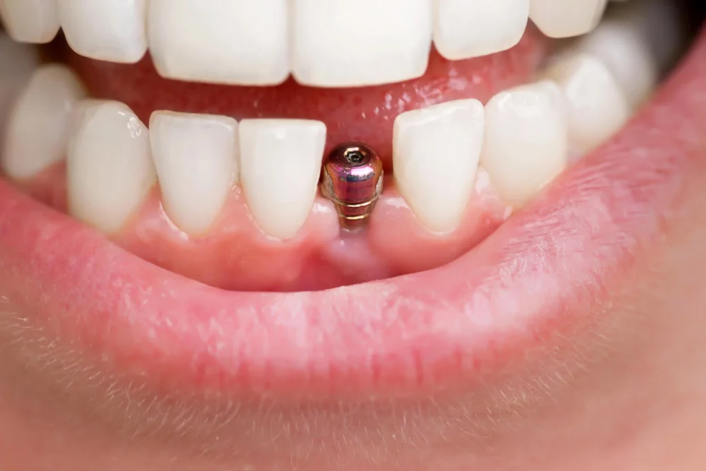 Close-up-of-single-tooth-implant-during-dental-implants-in-South-Charlotte