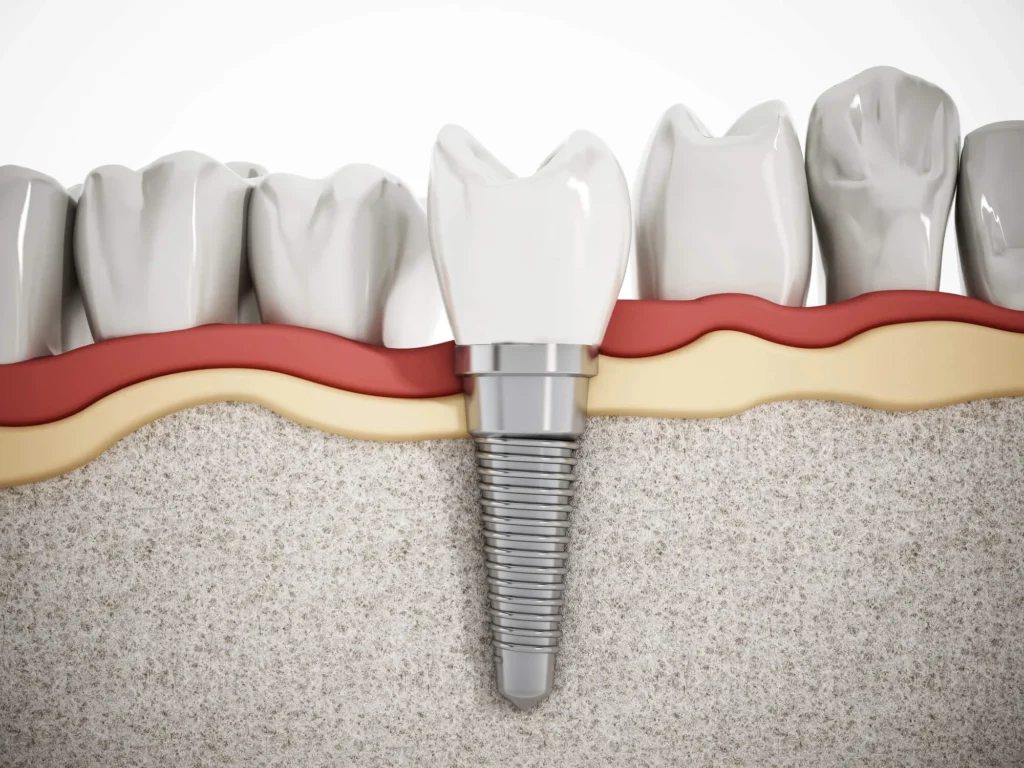 Dental-implant-model-showing-placement-for-dental-implants-in-South-Charlotte