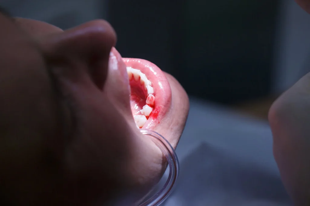 Dental implant site after tooth loss — affordable dental implants in South Carolina