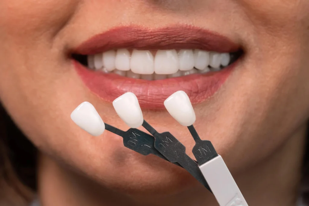 Veneer shades from a cosmetic dentist in Fort Mill.